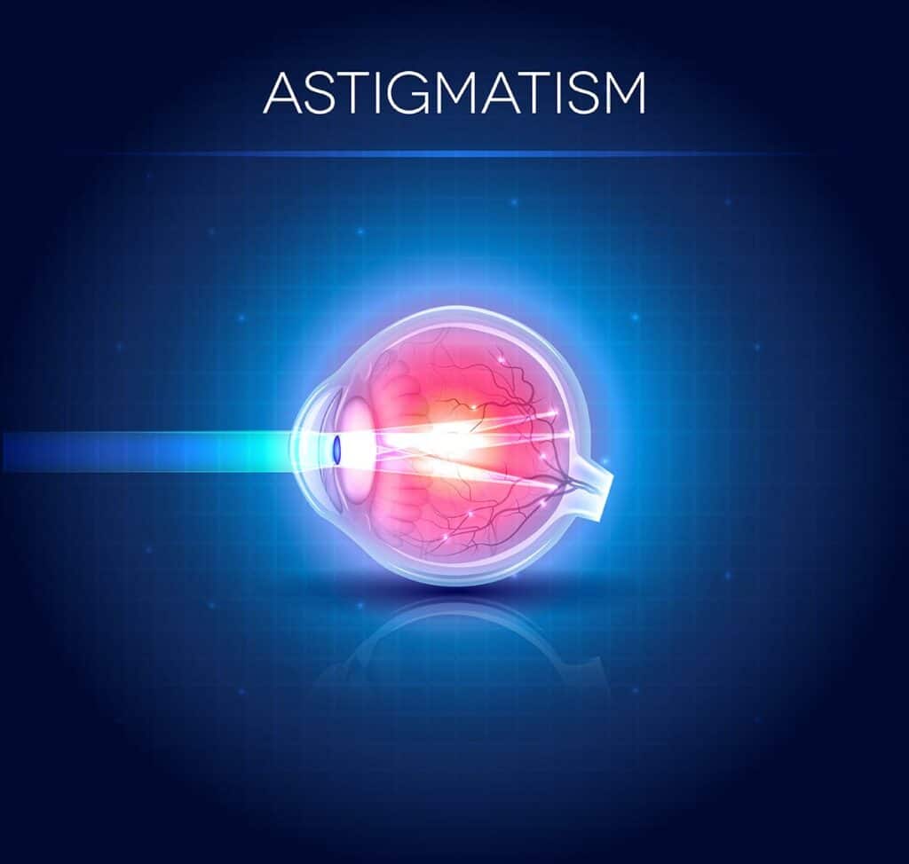 Astigmatism