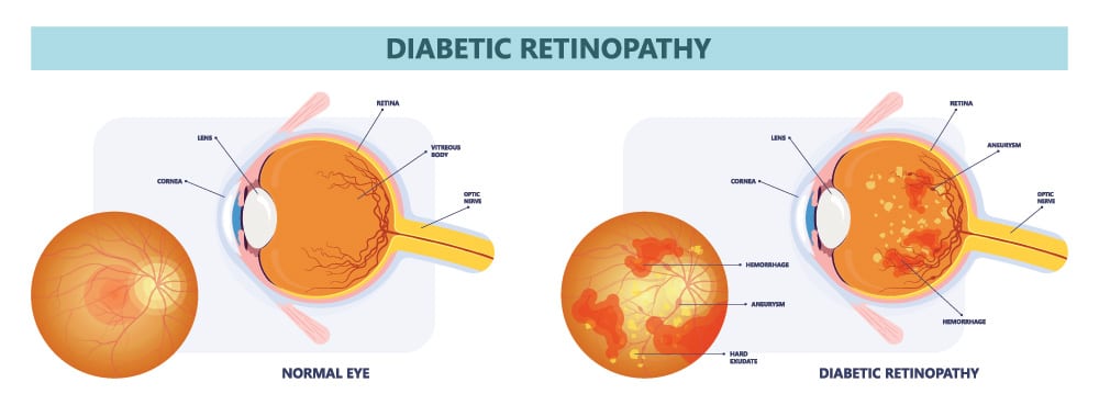 Chart Illustrating How Diabetic Retinopathy Affects an Eye