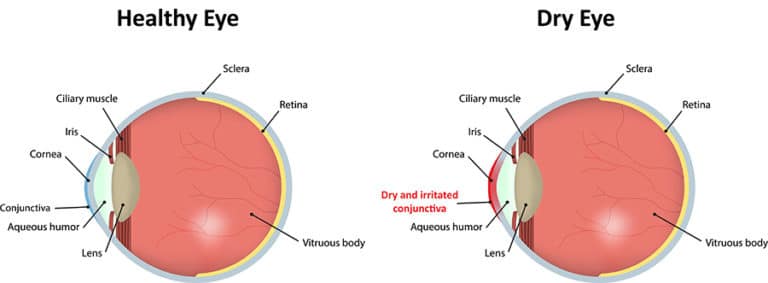 Chart illustrating a healthy eye vs one going through dry eye