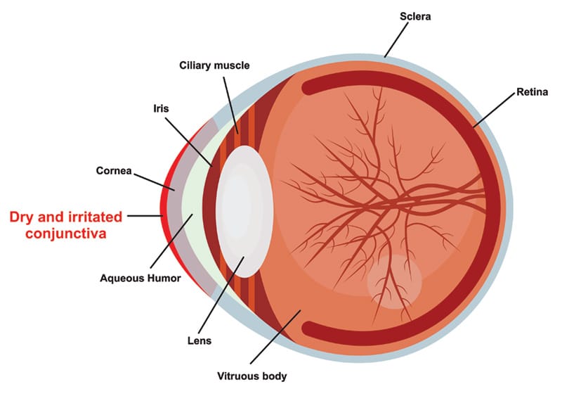 Chart illustrating how dry eye affects an eye