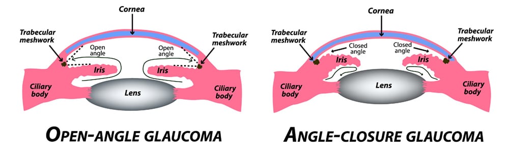 Chart Illustrating how open-angle glaucoma and angle-closure glaucoma affect an eye