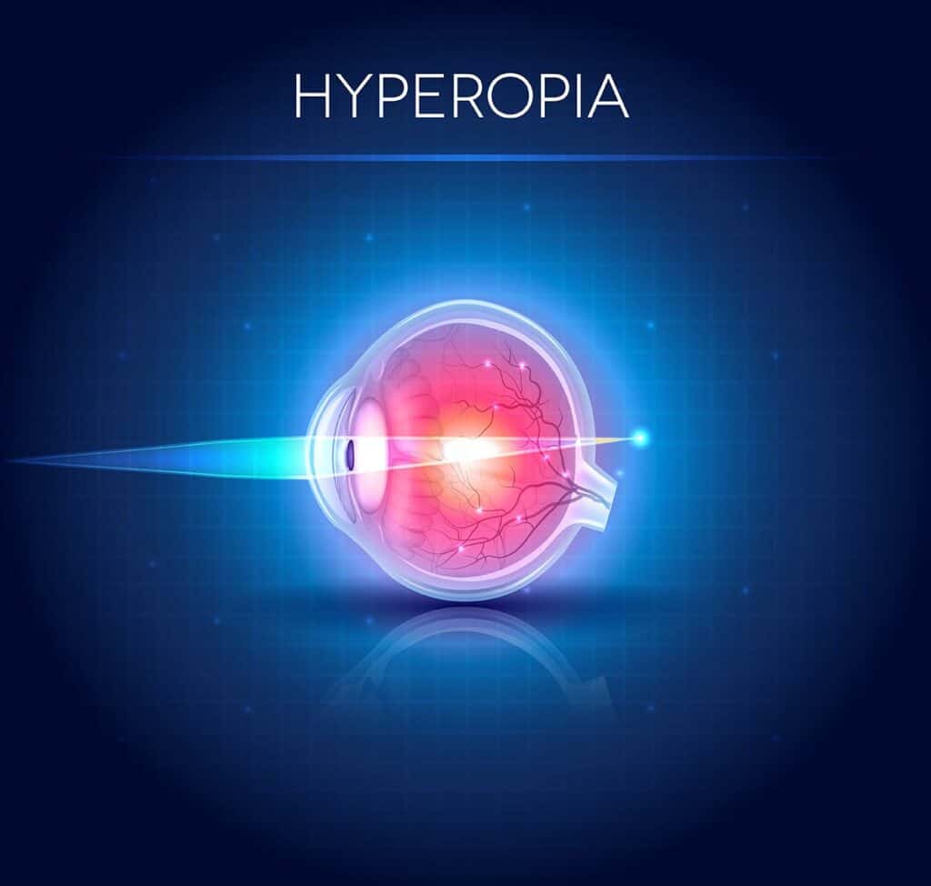 Hyperopia