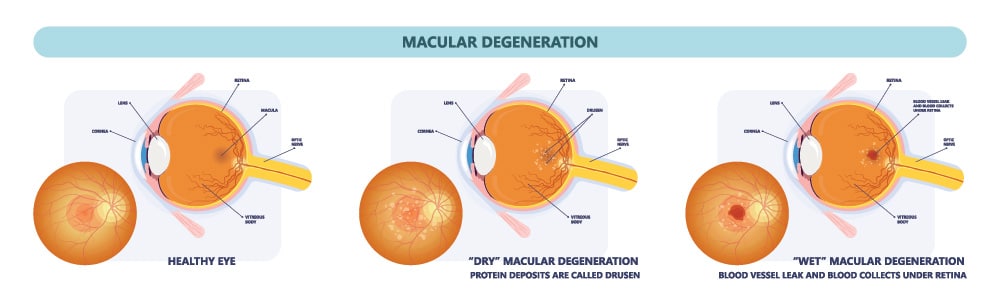 Chart Illustrating How Macular Degeneration Affects an Eye