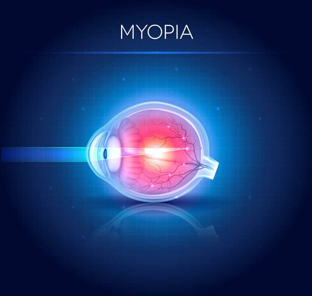 Myopia