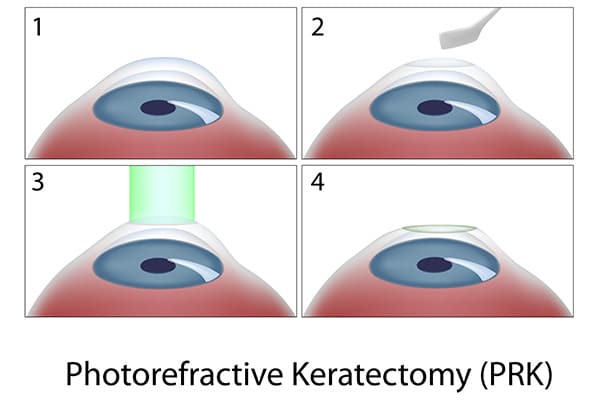 Chart Illustrating the PRK Surgery Process