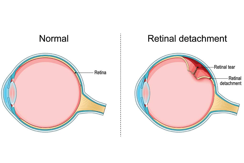 Chart illustrating a normal eye compared to one with a retinal detachment